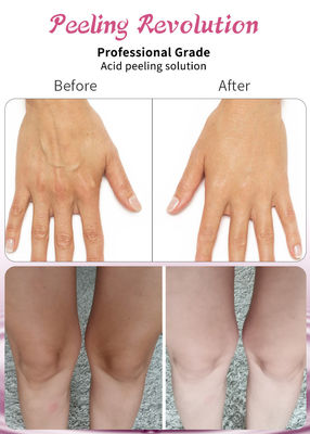Professional Grade Acid Skin Peeling Solution Liquid Set for Face Exfoliation