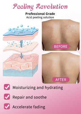 Exfoliating Serum Skin Peeling Solution Acne Remover Skin Care Skin Peeling 30ml